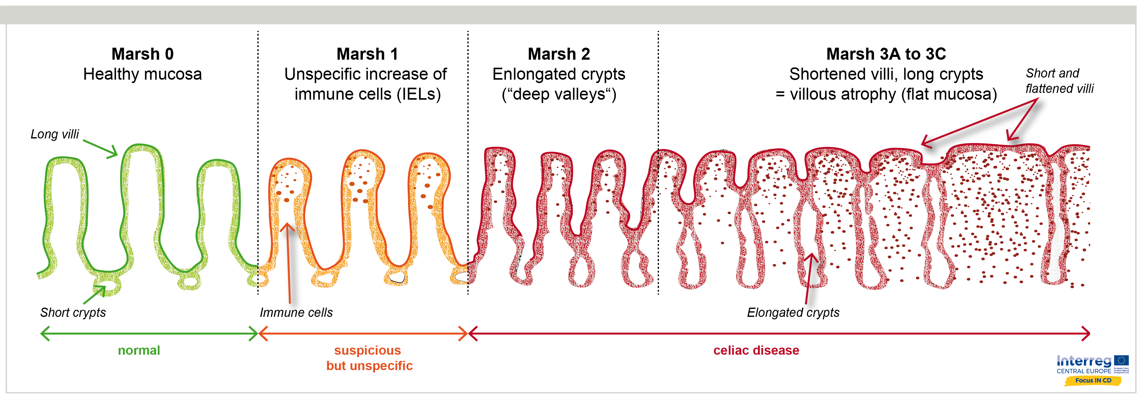 How Accurate Is Endoscopy For Celiac at Candice Rocha blog